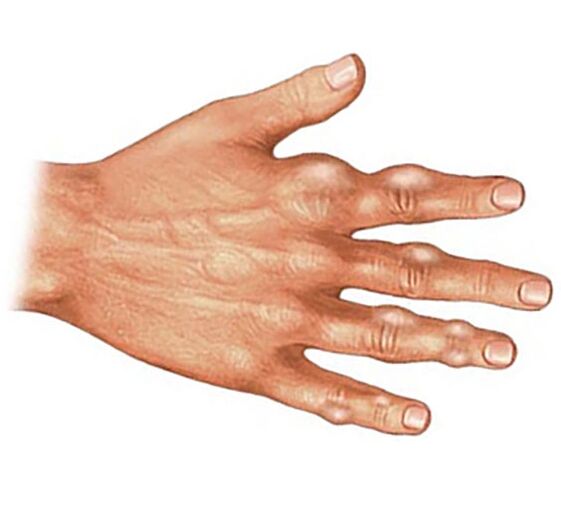 Отлагане на кристали пикочна киселина в меките тъкани на пръстите при подагрозен артрит