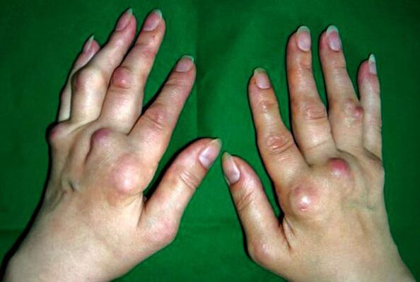 Ръце, засегнати от деформиращ полиостеоартрит