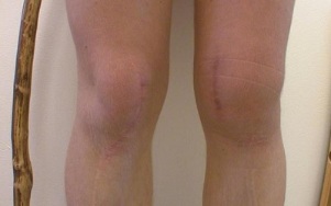 етапи на развитие на артроза на коляното