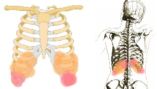 болки в гърба под ребрата симптоми