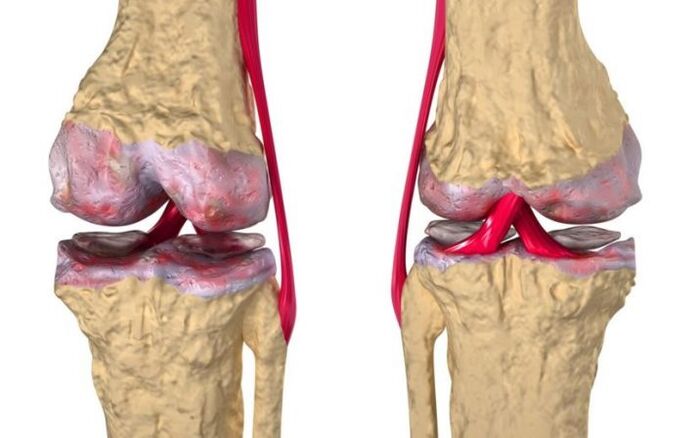 Артроза на колянната става